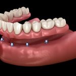 Can_i_ask_my_dentist_to_remove_all_my_teeth