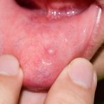 Can_you_get_a_pimple_inside_your_mouth