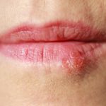 Can_you_have_sex_with_a_cold_sore