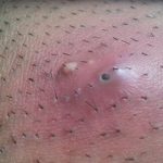 Can_you_have_sex_with_ingrown_hair_bumps