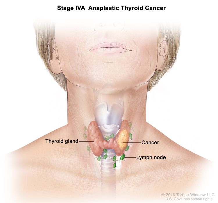 Cat Swollen Lymph Nodes Side of Neck Iodine Radioactive