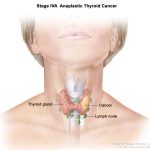 Cat_swollen_lymph_nodes_side_of_neck_iodine_radioactive