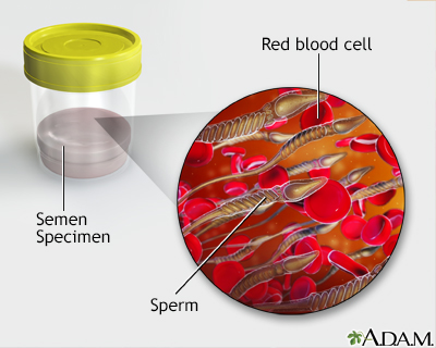 Causes For Blood In Semen