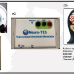 Chronic_white_matter_brain_disease_understanding_the_condition