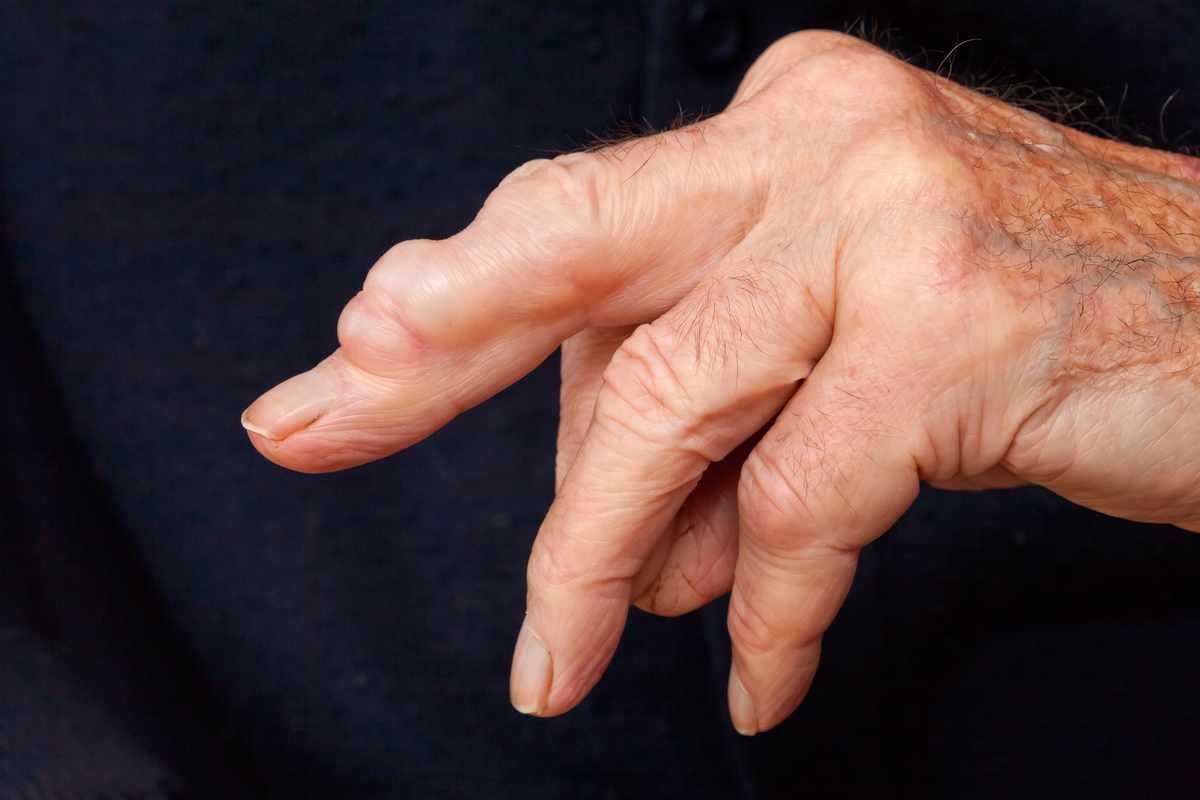Discovering Bumps on Finger Near Nail_ Causes_ Symptoms_ and Treatment Options