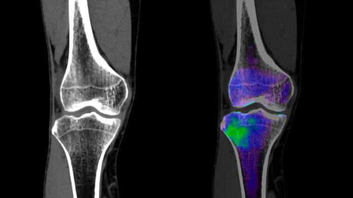 Effective Treatment for Bone Marrow Edema in the Spine