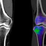 Effective_treatment_for_bone_marrow_edema_in_the_spine