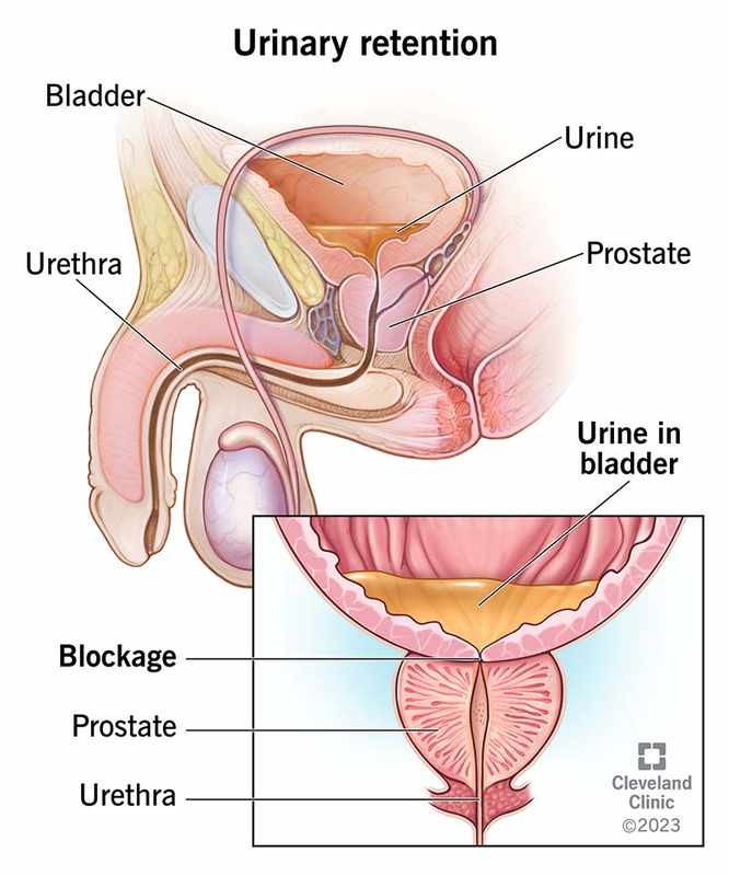 Frequent Urination and Retention_ Causes in Young Men
