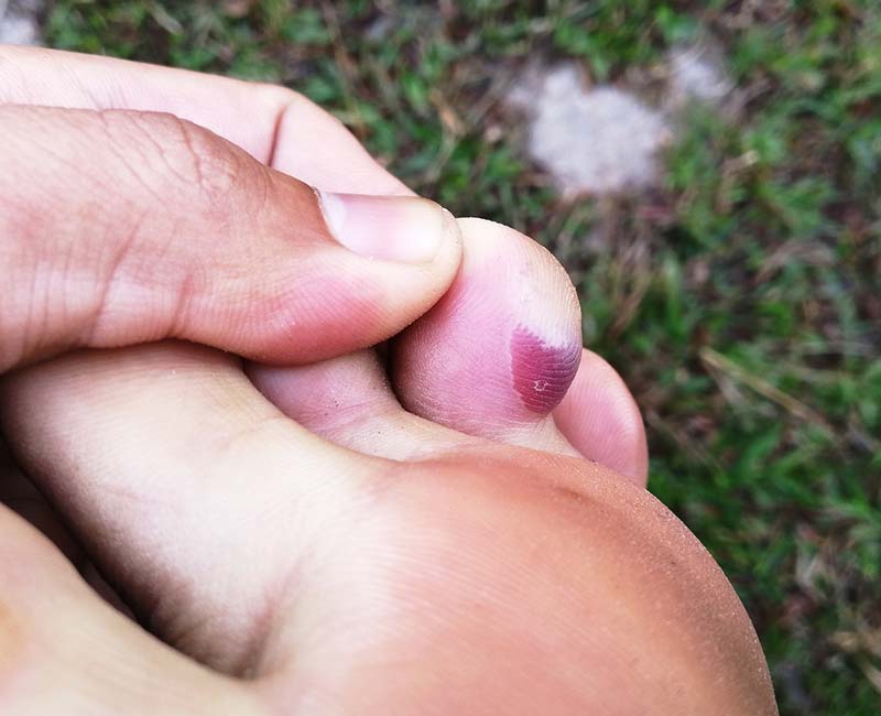 Hands and Fingers_ Treatment for Blisters