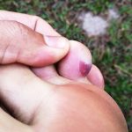 Hands_and_fingers_treatment_for_blisters
