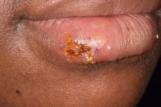 Having Sex with Cold Sore on Lip_ Is It Safe_
