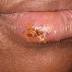Having_sex_with_cold_sore_on_lip_is_it_safe