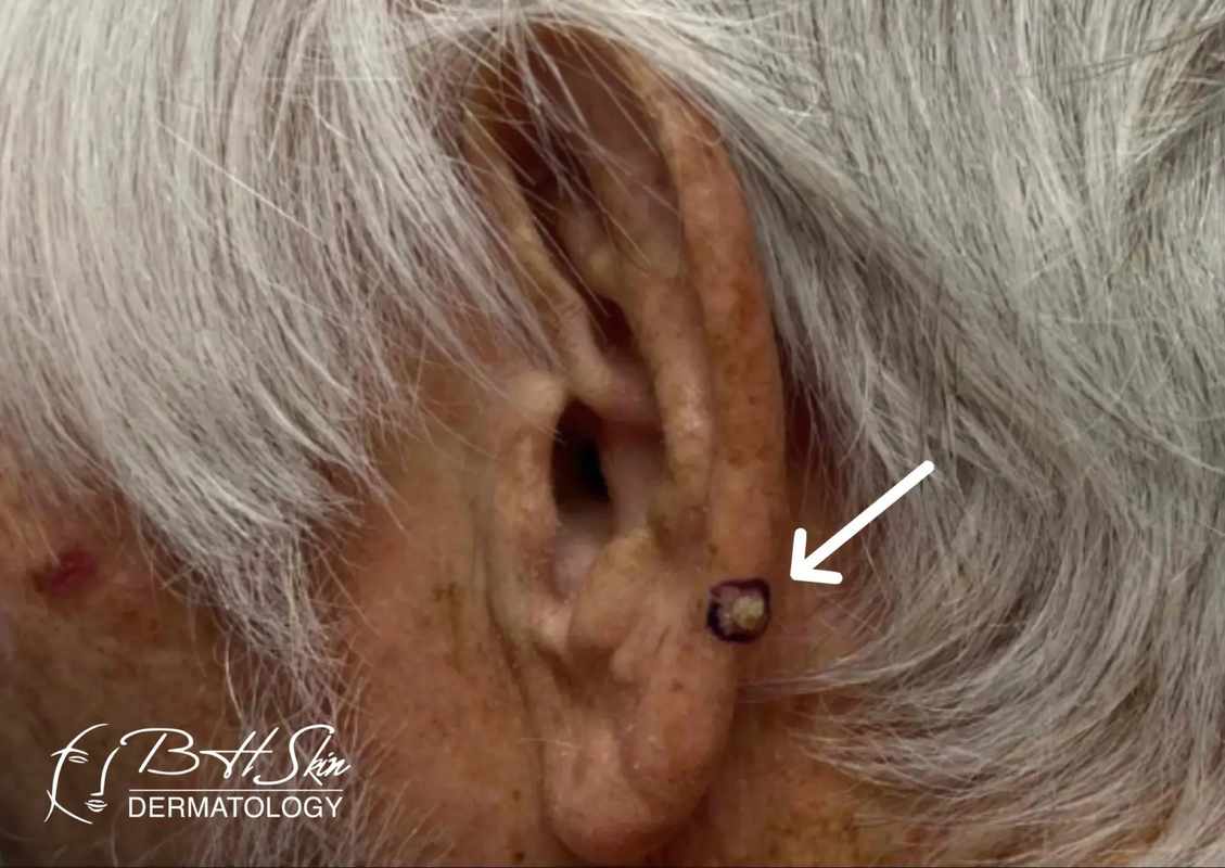 How to Get a Bump Behind Ear Lobe Piercing_ A Comprehensive Guide