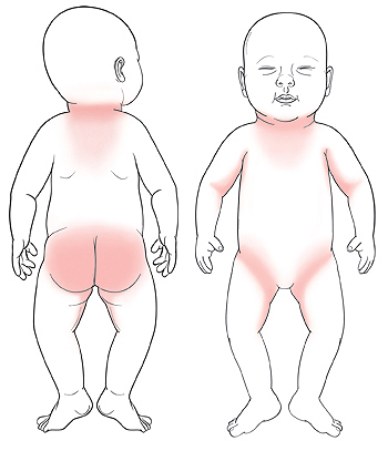 How to Treat Baby Heat Rash on Neck