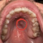 Hurts_bump_on_the_roof_of_my_mouth