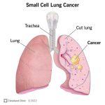 Lung_cancer_symptoms_cat_dying_from_lung_cancer