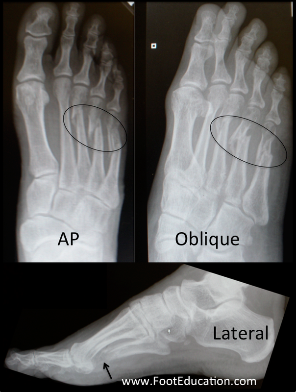 Non-Displaced 2nd Metatarsal Fracture