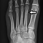 Non-displaced_2nd_metatarsal_fracture