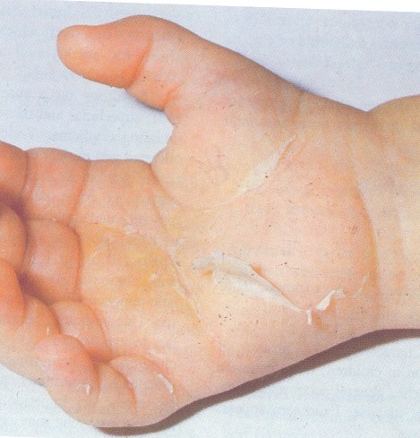 Peeling Skin on Fingers in 3 Year Old