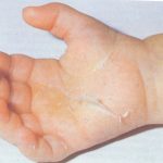 Peeling_skin_on_fingers_in_3_year_old