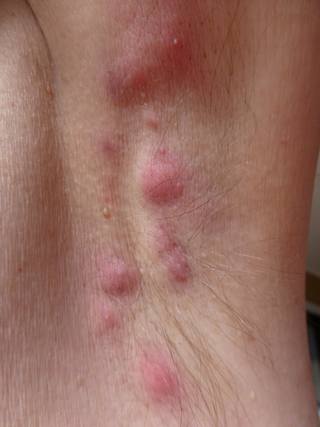 Recurring Abscess Under Arm_ Persistent Treatment Needed