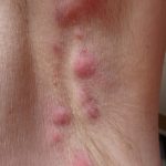 Recurring_abscess_under_arm_persistent_treatment_needed