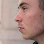 Scalp_masturbation_understanding_bumps_on_scalp_during_masturbation