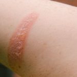 Second_degree_burns_caring_for