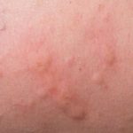 Side Effects of Amoxicillin and Clavulanate What You Need to Know_1