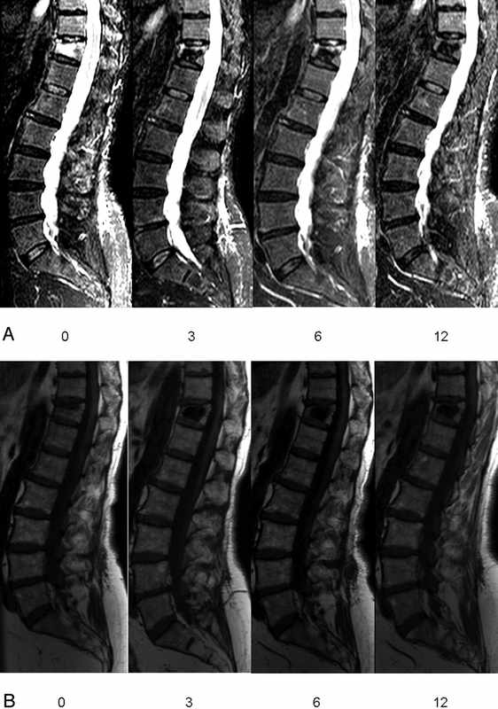 Spine Treatment for Bone Marrow Edema