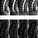Spine_treatment_for_bone_marrow_edema