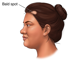The Balding Spot on Back of Head_ Understanding and Treating