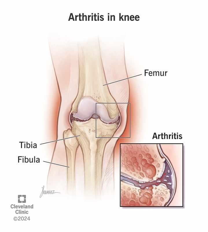 The Best Pain Relief Options for Arthritis in Knees