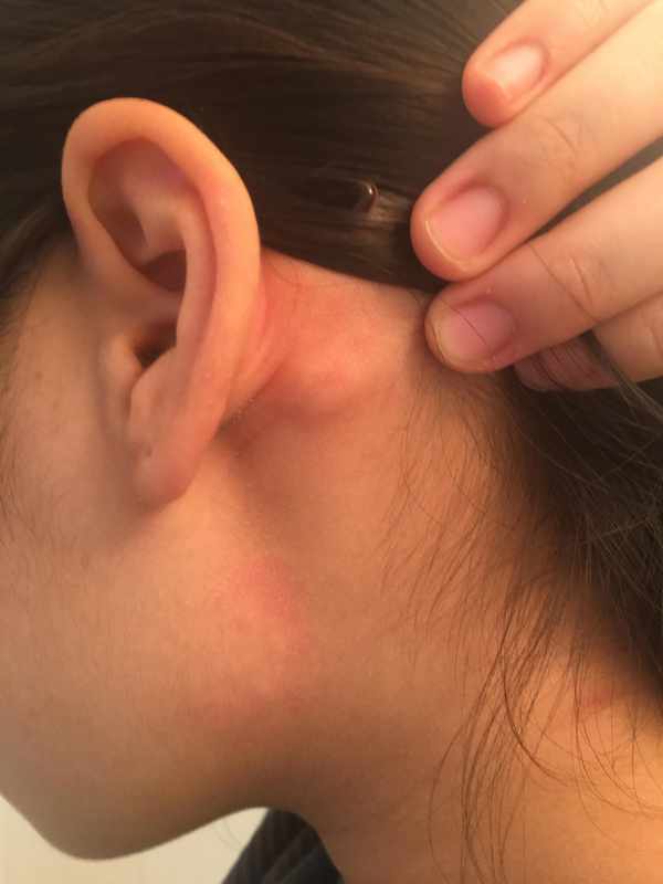 The Bony Bump Behind Ear