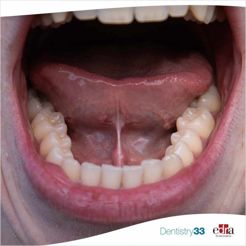 The Bump On Frenulum Under Tongue