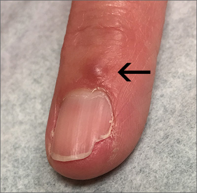 The Bump on Finger Near Nail Bed
