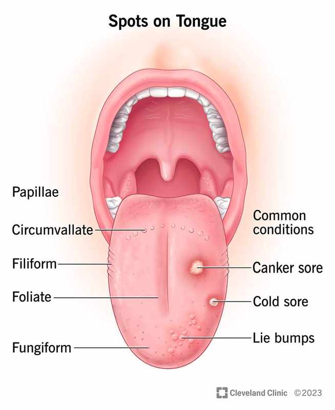 The Painless Bump Under Tongue_ Understanding Its Causes