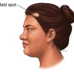 Side view of a woman’s head with alopecia areata.