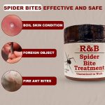 The_best_home_treatment_for_brown_recluse_spider_bite