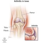 The_best_pain_relief_options_for_arthritis_in_knees