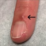 The_bump_on_finger_near_nail_bed