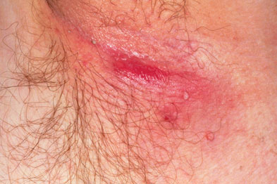 Under Arm Clogged Sweat Gland