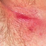 Under_arm_clogged_sweat_gland