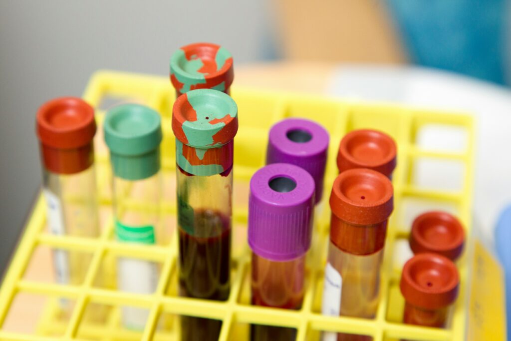 Understanding Blood Test Sex Hormone Binding Globulin
