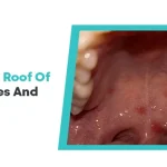 Understanding Bumps On The Roof Of Mouth Causes And Treatment Options_1