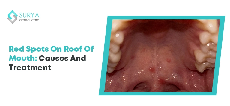 Understanding Bumps On The Roof Of Mouth_ Causes And Treatment Options