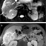 Upper_right_quadrant_pain_a_40-year-old_male_presentation