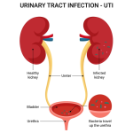 Urinary Tract Infections Caused by Bacterial STI_1
