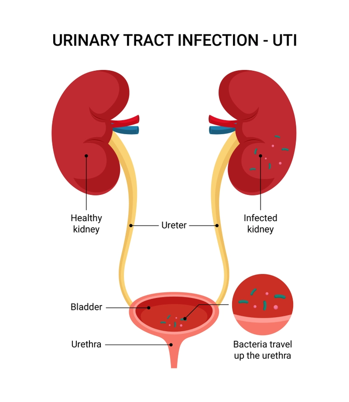 Urinary Tract Infections Caused by Bacterial STI