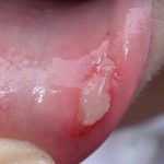 What Is a Canker Sore on the Penis Head_1
